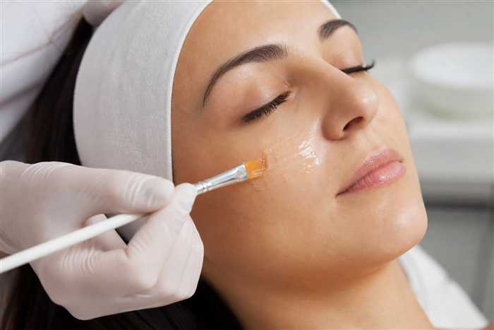 Peeling químico ou físico